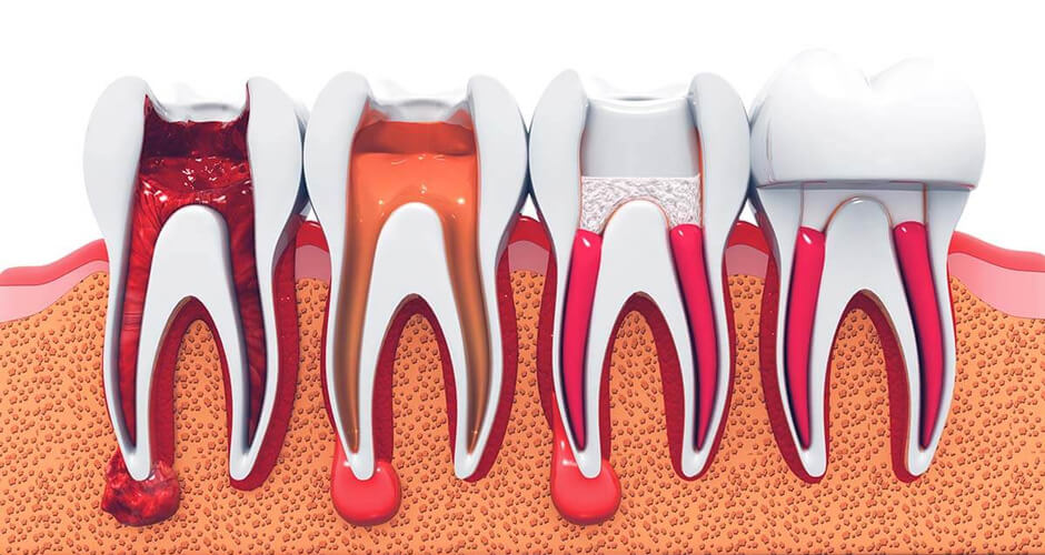 Image of various stages of a root canal therapy procedure on a patient's tooth. This image represents the root canal therapy services provided by Aspen Dental Care in Calgary